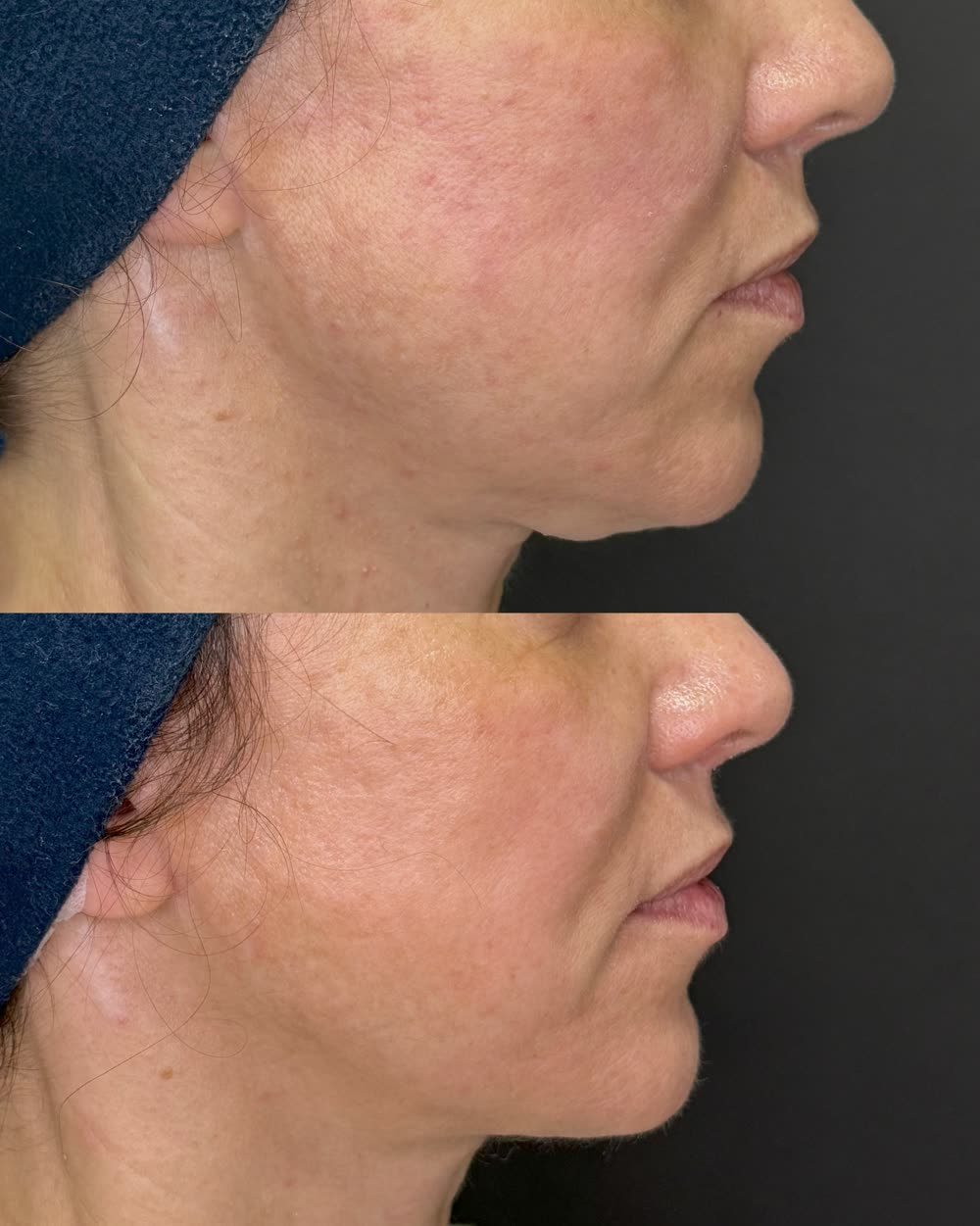 Antes e depois de face completa tratada com Ultraformer MPT em sessão única, resultado após 45 dias