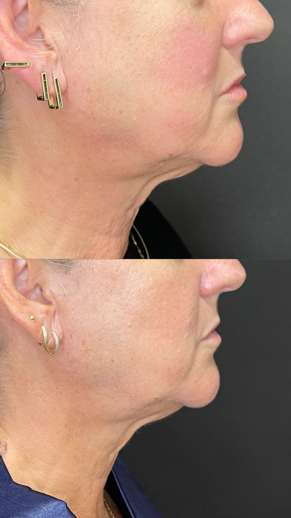 Antes e depois de papada e pescoço tratados com Ultraformer MPT em sessão única, resultado após 45 dias