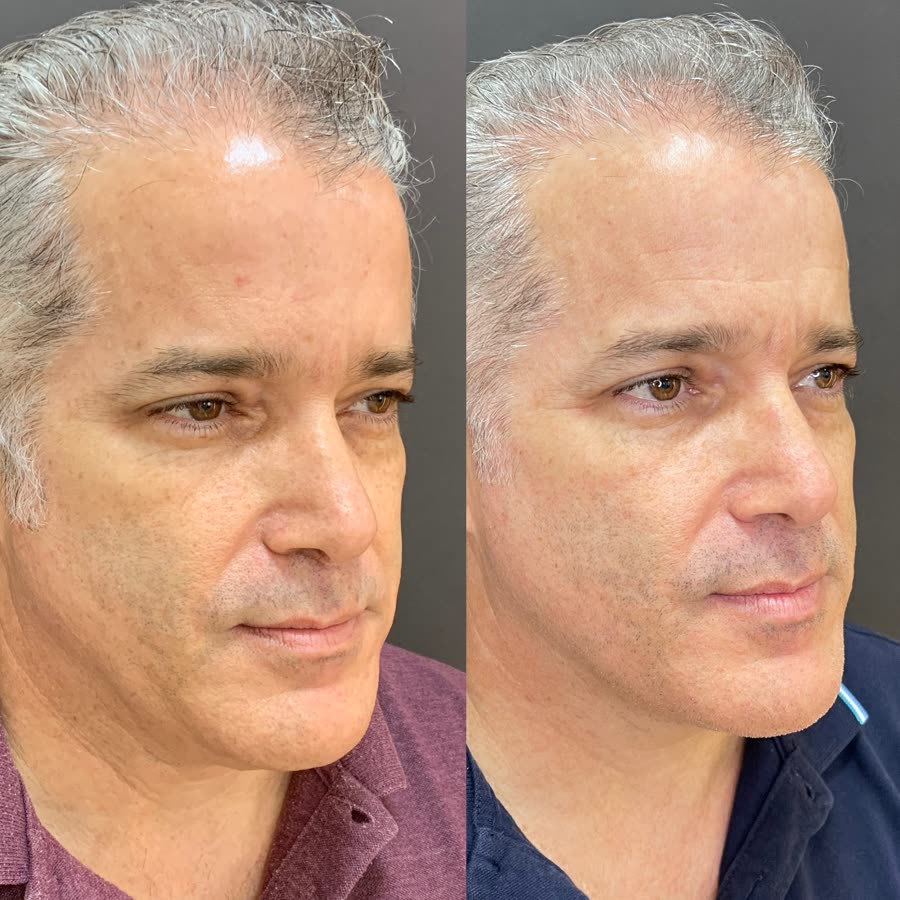 Antes e depois de paciente masculino tratado com Ultraformer MPT, resultado após 45 dias